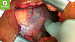 MICS CABG (Kale Suresh Babu et al)