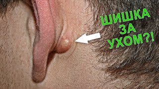 ШИШКА ЗА УХОМ И ЕЕ ЛЕЧЕНИЕ