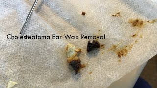 519 - Cholesteatoma Ear Wax Removal