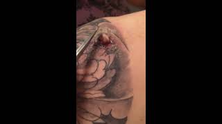 Infected abscess on tattoo