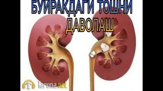 ЖИГАРНИ КОННИ ТОЗАЛАШ ВА БУЙРАКДАГИ ТОШНИ ТУШИРИШ
