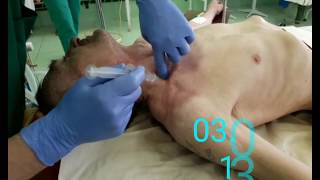 Блок плечевого сплетения по Куленкампфу. Brachial plexus block paresthesia technique