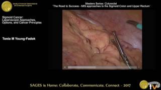Sigmoid cancer: Laparoscopic approaches, options & cancer principles
