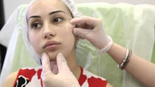 Коррекция скул. Коррекция подбородка. Коррекция овала лица