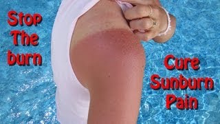 Home Remedies For Sunburn Relief