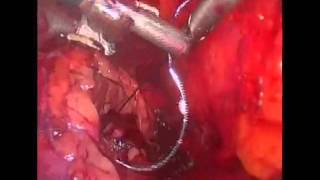Лапароскопическая резекция левой почки Laparoscopic partial neprectomy