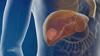 Laparoscopic liver surgery at UPMC