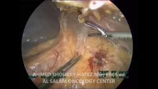 laparoscopic left adrenalectomy.استئصال الغدة الكظريةبالمنظار الجراحي دكتور احمد شكري