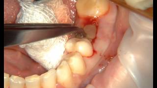 Лечение альвеолита с помощью Clot-PRF. Treatment of alveolitis with Clot-PRF.