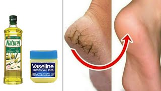 Do This Simple Home Remedy With Vaseline To Get Rid Of Cracked Heels In 3 Days