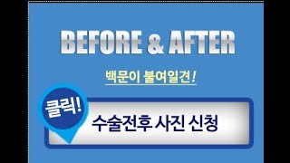남성수술 전후사진 대방출! 2탄(연령제한)