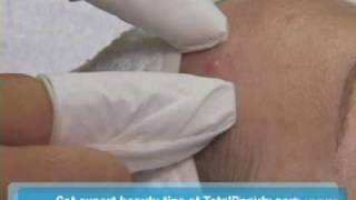 How to Pop a Pimple on Your Skin the Right Way