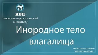 887  Инородное тело влагалища