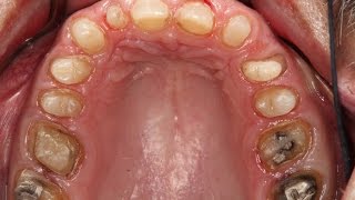 Full-Mouth Rehabilitations Part: 2