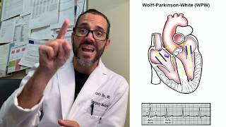 Wolff Parkinson White Syndrome - Patient Education