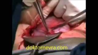 Sezeryan Doğum, Sezeryan Nasıl Yapılır Video, Epidural Sezeryan Nedir +18