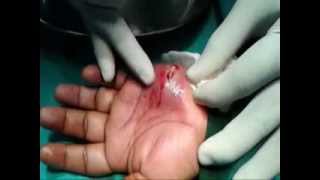 I & D of hand Abscess