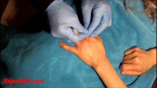 Watch Hand Injections-Artefill Dr Rajani