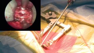 Chirurgie hernie discale cervicale avec pose de prothèse en ambulatoire - CHU de Bordeaux