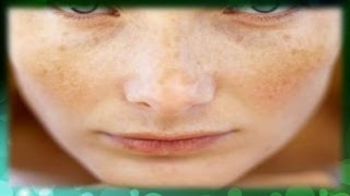 Remedios caseros y naturales para manchas en la cara - Mascarilla de Sábila (Aloe Vera)