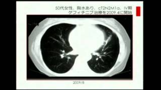 日本のがん臨床研究・臨床試験（特に肺がん）の現状- 光冨 徹哉