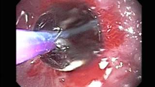 Endoscopy of Esophageal Dilation Peptic Stenosis