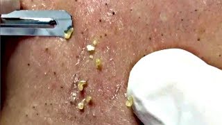 Best Blackheads Remover (Part 02)