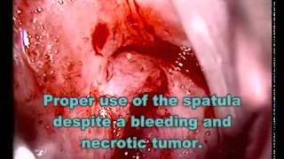 Szalay Tutorial part 2 : Cervical Pathalogy, Colposcopy and Cytology. Szalay Pap test device.