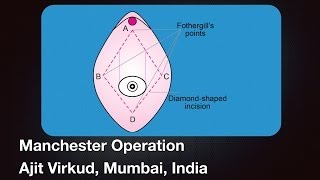 Manchester Operation showing Fothergill's points and stitch and Sturdorm sutures