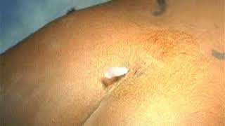 Caudal sacral block in Pediatric anaesthesia