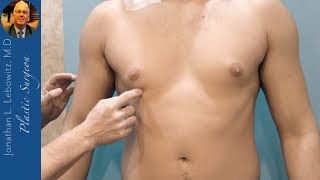 19 y/o Male Pubertal Gynecomastia Gland Surgery, The Long Island Gynecomastia Center By Dr. Lebowitz