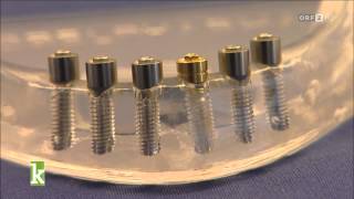 Konkret Reportage - Mini Implantate als billiger Zahnersatz