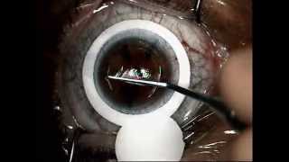 laser miopia lasik by Tsioumas Sotiris 8