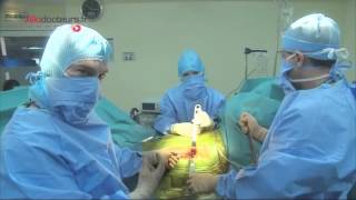 Prothèse totale de hanche : la technique mini-invasive - Allô Docteurs