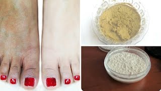 পায়ের কালো দাগ দূর করার ঘরোয়া উপায়