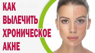 Как вылечить хроническое акне
