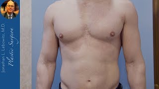 Montreal Canadian Patient Gynecomastia Gland Removal Surgery By Dr. Lebowitz Long Island NY
