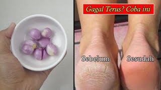 BOCOR... RESEP ALAMI PALING MANJUR MENGATASI TUMIT KAKI PECAH-PECAH AKHIRNYA TERUNGKAP
