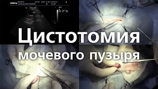 Удаление камня из мочевого пузыря. Цистотомия мочевого пузыря