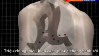 Triệu chứng, biểu hiện cách phòng chống bệnh sởi