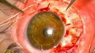 Intraocular tumor Surgery, Melanoma