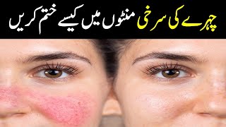 How to Remove Face Redness Naturally Urdu Hindi