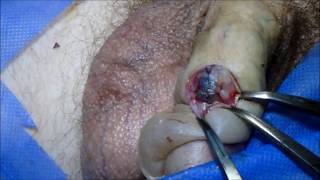 cirugía para enfermedad de Peyronie