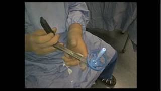 Total Laparoscopic Hysterectomy in the Clinical Setting Part 1
