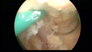 Asherman's Syndrome