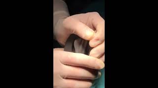 Child Circumcision