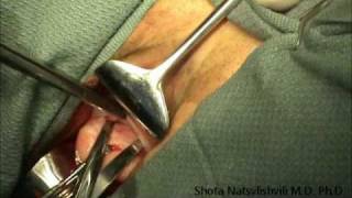 Vaginal Hysterectomy. Uterine Fibroids