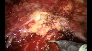 Robot-assisted Radical Cystectomy And Intracorporeal Urinary Diversion - Part 1