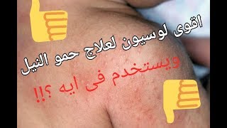 اقوى لوسيون لعلاج حمو النيل \وحروق الشمس للاطفال والكبار \واسوءهم عن تجربة \والنتيجة سحرية