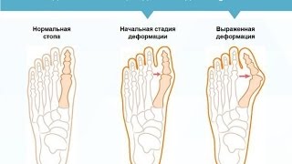 Вальгус плюс купить в Спб